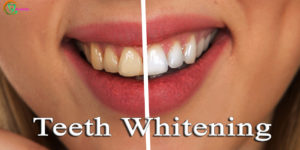Teeth Whitening – Keep Your Smile Shining Ever!
